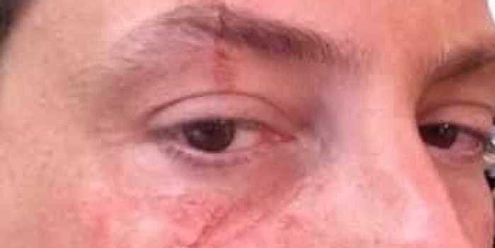 Panela de pressão provoca queimadura no rosto de Danilo Gentili