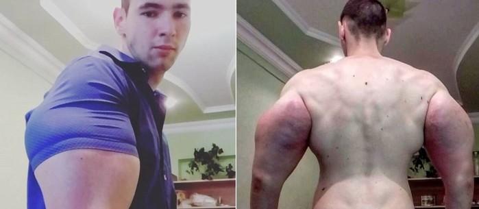 Jovem russo ganha 'supermúsculos' injetando óleo no corpo