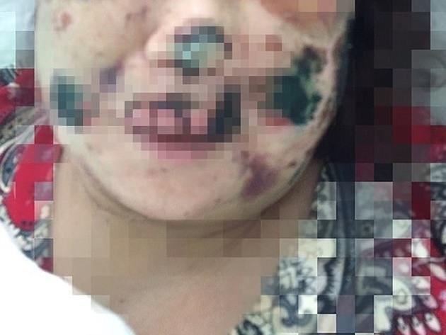 Mulher perde orelha e parte do nariz após ter encontro com canibal