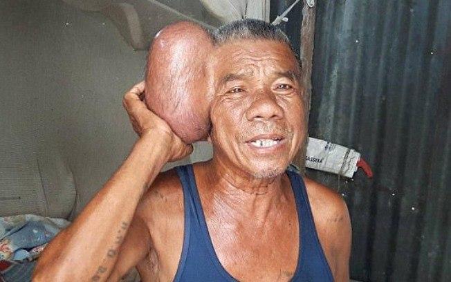 Homem passou 10 anos com tumor de 2kg na cabeça (Crédito: Twitter)