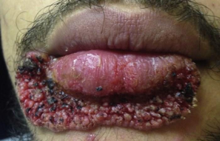 Homem tira espinha com lâmina de carpintaria e contrai fungos