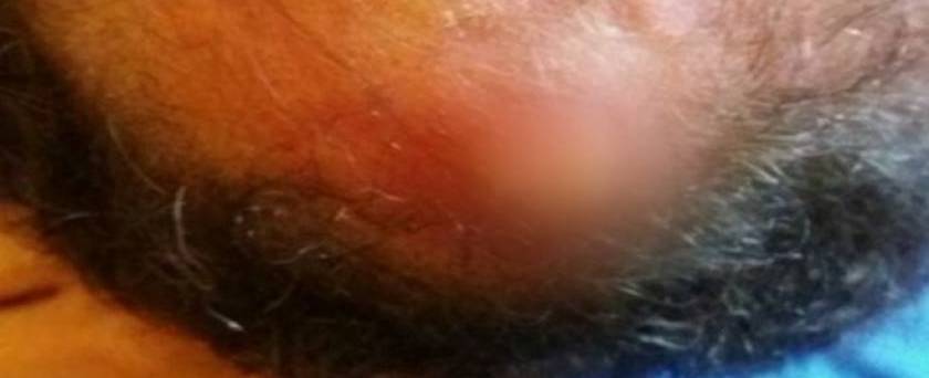 Morre homem que teve gaze esquecida dentro da cabeça