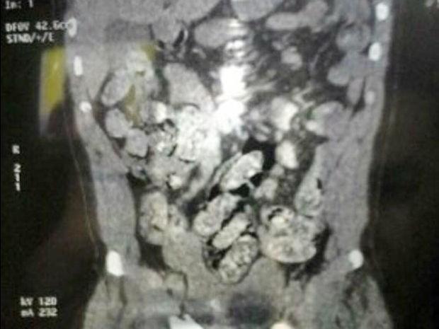 Raio-X mostra cápsulas de cocaína no estômago do boliviano que foi detido em Cáceres (Crédito: Reprodução)