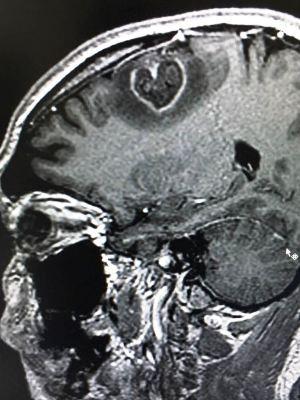 Tumor no cérebro tinha formato de coração