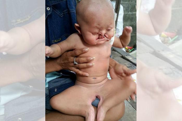“Bebê sereia” luta para conseguir tratamento contra rara síndrome