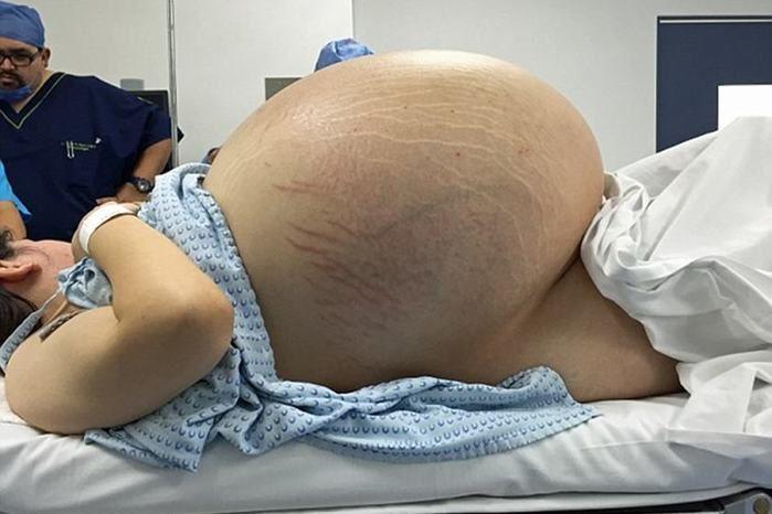 Médicos removem cisto de 32kg que crescia em ovário de jovem