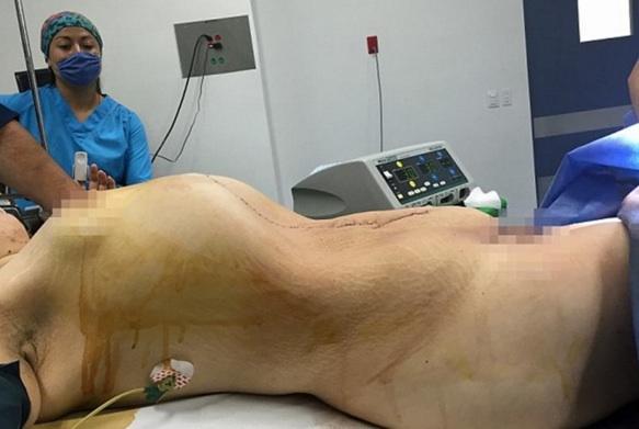 Médicos removem cisto de 32kg que crescia em ovário de jovem