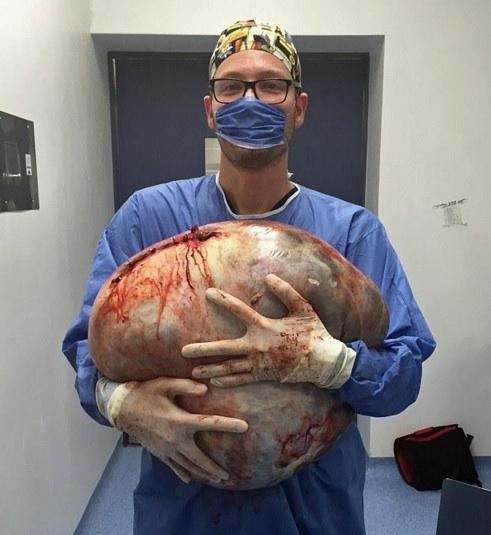 Médicos removem cisto de 32kg que crescia em ovário de jovem