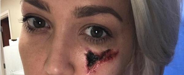 Cantora mostra como ficou seu rosto após ser picada por uma aranha