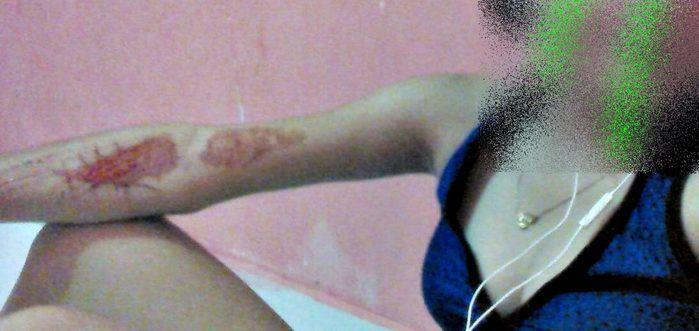 Baleia Azul: Adolescente divulga fotos com marcas de mutilação