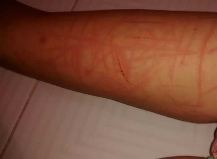 Baleia Azul: Adolescente divulga fotos com marcas de mutilação