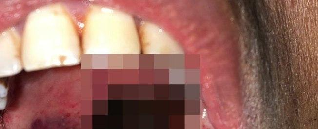 Médicos retiram peixe da garganta de pescador na Índia