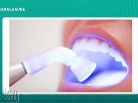 Clareamento dental prejudica os dentes? Veja no Canal Saúde!