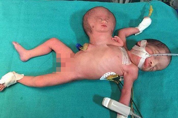 Bebê nasce com cabeça de irmão presa ao corpo e passa por cirurgia (Crédito: Reprodução)