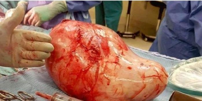 Mulher vai a hospital e descobre pedra de quase 1 kg na bexiga
