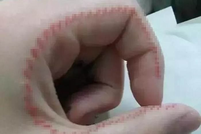 Novo desafio da internet faz jovens costurarem a própria pele