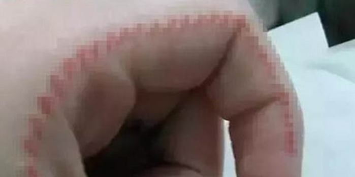 Novo desafio da internet faz jovens costurarem a própria pele