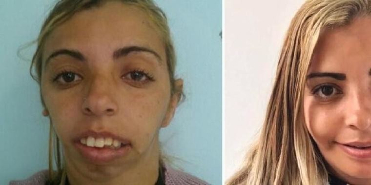 Mulher chamada de "monstro", faz cirurgia e fica irreconhecível