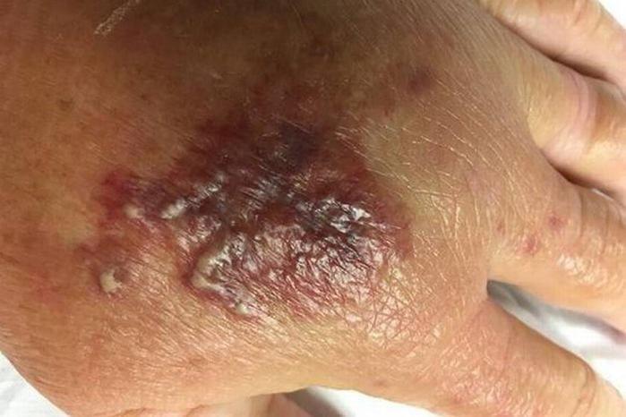 Mulher se machuca e contrai bactéria que come carne humana