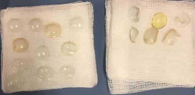 Médicos encontram 27 lentes de contato em olho de paciente