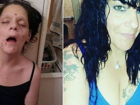Ex-viciada em heroína posta fotos chocantes e diz:"Estava morrendo"