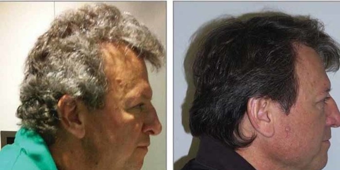 Nova droga usada em quimioterapia pode dar cor ao cabelo grisalho