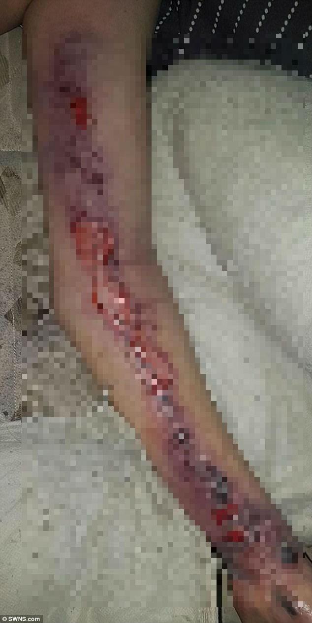 Jovem morre após contrair bactéria durante sexo com namorado