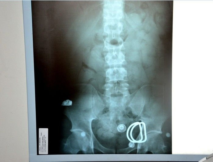 Radiografia mostrou a droga no estômago do venezuelano