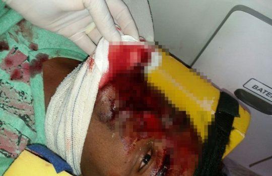 Homem tem o rosto desfigurado após colidir moto em muro