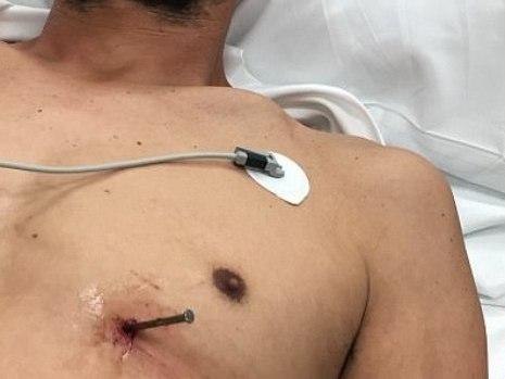 Homem dispara pistola de pregos e atinge o próprio coração