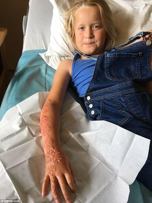 Tatuagem de henna gera cicatrizes permanentes em menina de 7 anos