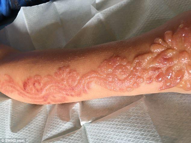 Tatuagem de henna gera cicatrizes permanentes em menina de 7 anos