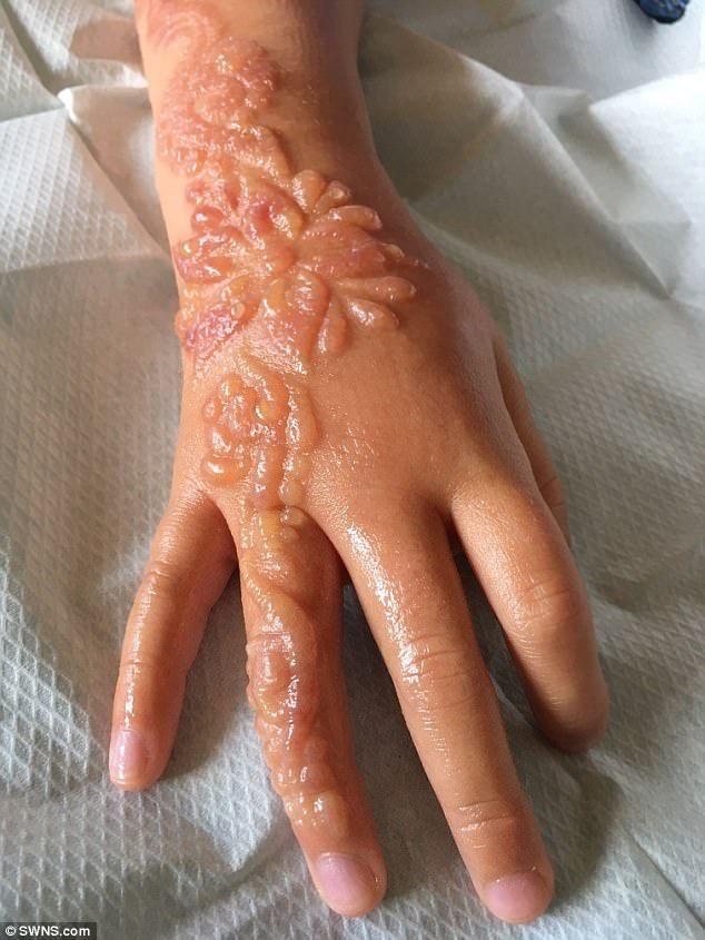 Tatuagem de henna gera cicatrizes permanentes em menina de 7 anos