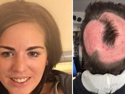 Jovem tenta ter "cabelo de unicórnio" e perde o couro cabeludo