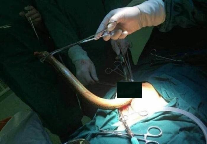 Mulher que introduziu enguia viva na vagina passa por cirurgia 