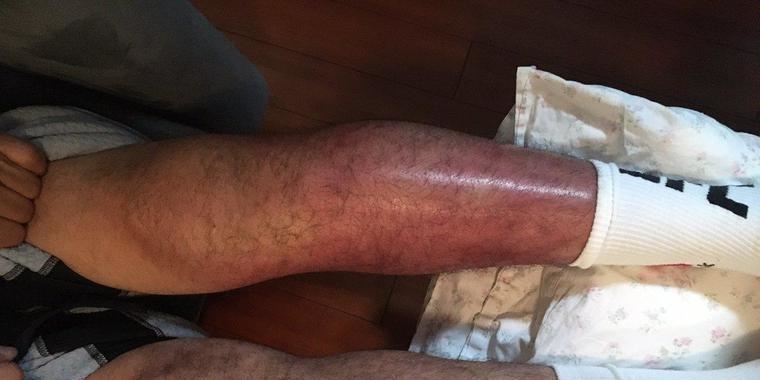 Após derrota no UFC, lutador mostra lesão assustadora na perna