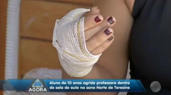 Professora levou dois pontos na mão (Crédito: Rede Meio Norte)