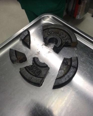Pênis ficou entalado no centro de uma anilha de metal (Crédito: Reprodução)