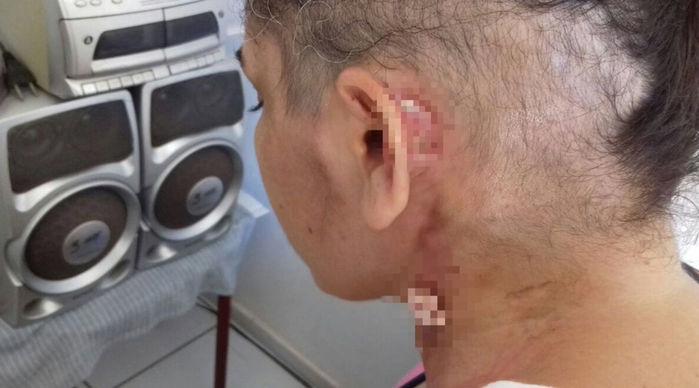 Bactéria surgiu após a dona de casa ter uma caxumba (Crédito: Reprodução)