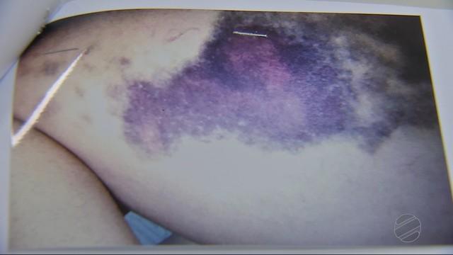 Vítima exibe hematomas após agressões (Crédito: V Centro América)