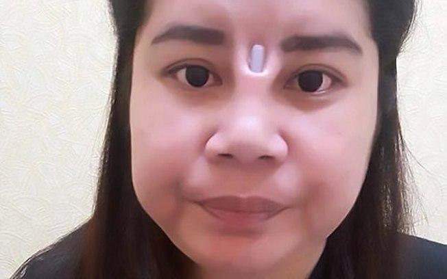 A rinoplastia desta tailandesa também teve complicações, e o implante de silicone rompeu o seu rosto
