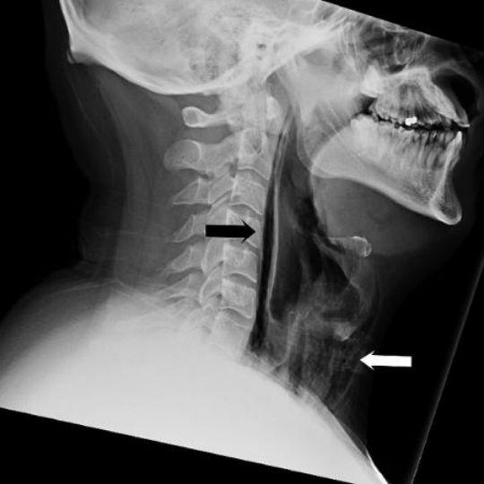 Setas indicam fratura na garganta de homem que segurou espirro (Crédito: BMJ Case Reports)