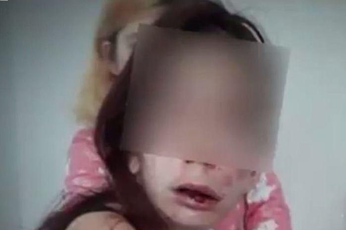 Jovem deficiente é agredida e tem mãos queimadas por adolescentes