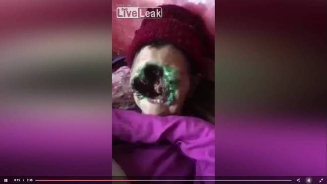 Detentos Seguem Internados Com Doenca Misteriosa Que Come Pele Em Roraima Brasil Estadao