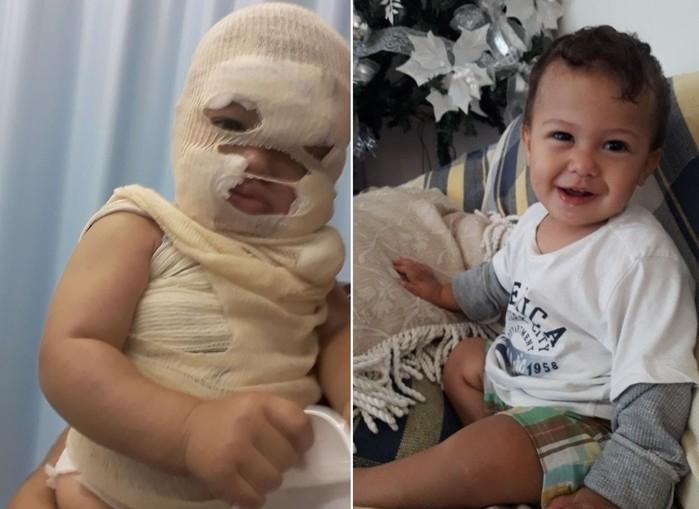 Bebê tem rosto desfigurado por água fervendo e pais fazem apelo