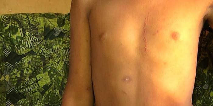 Criança de oito anos sofre descarga elétrica de fiação caída em rua