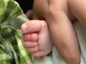 Bebe Quase Perde Quatro Dedos Do Pe Por Causa De Fio De Cabelo