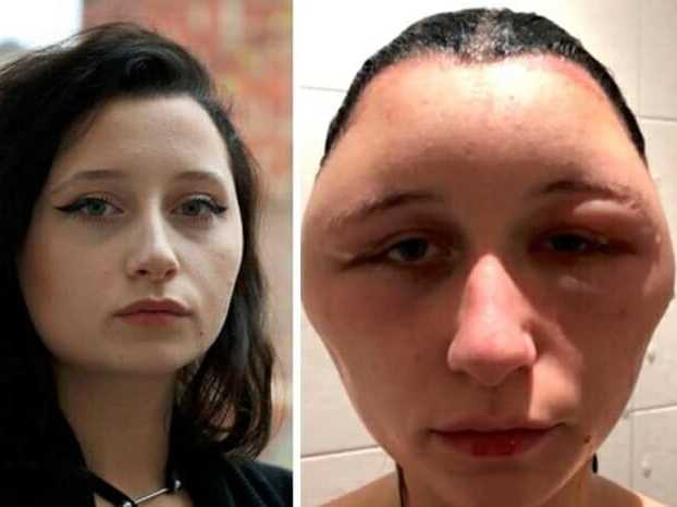 Jovem tem reação alérgica com tinta e cabeça dobra de tamanho