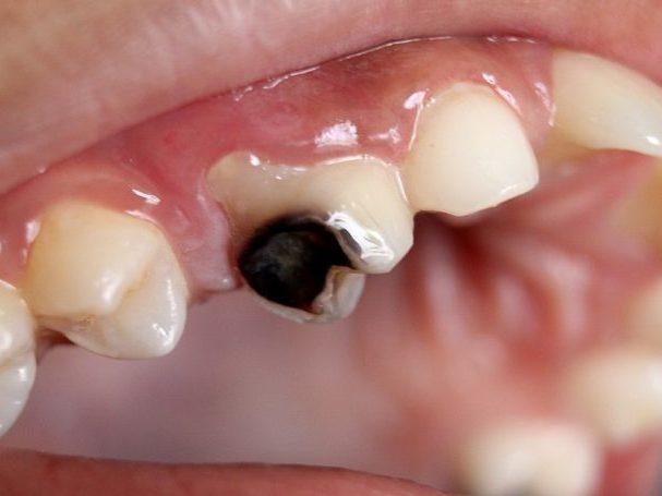 Confira hábitos simples de mudança para evitar cáries nos dentes