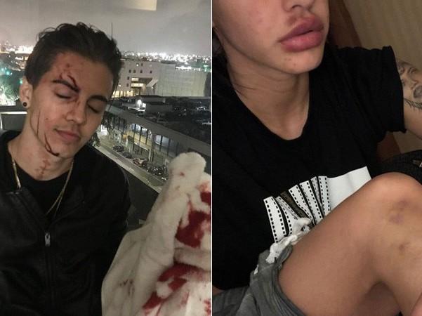 Biel leva 13 pontos na testa após agredir mulher nos Estados Unidos